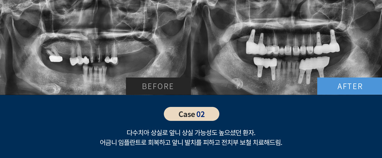 비포 애프터 이미지