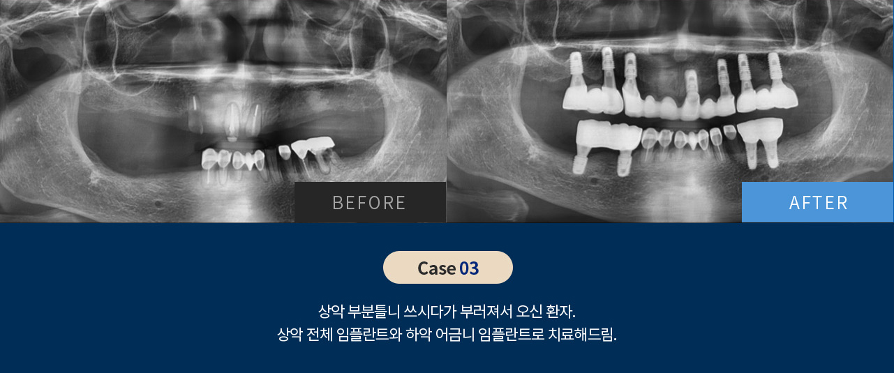 비포 애프터 이미지