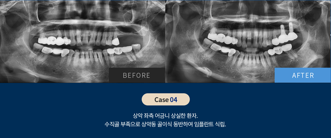 비포 애프터 이미지