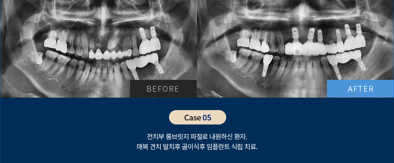 비포 애프터 이미지