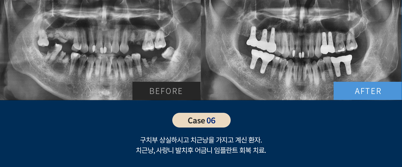 비포 애프터 이미지
